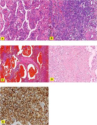 Correlation Between Pulmonary Sclerosing Pneumocytoma Features and MSCT Imaging Manifestations in 34 Patients: Implications for Precision Medicine